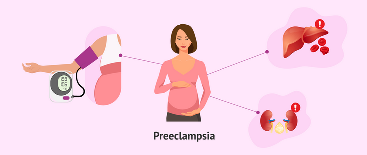 La preeclampsia, un factor de riesgo para la enfermedad renal crónica